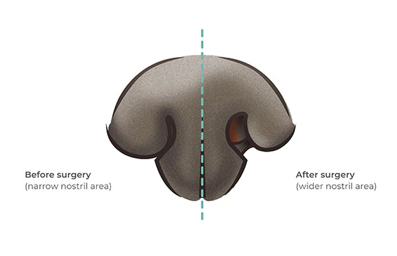FIG 1 - Widening the nostrils